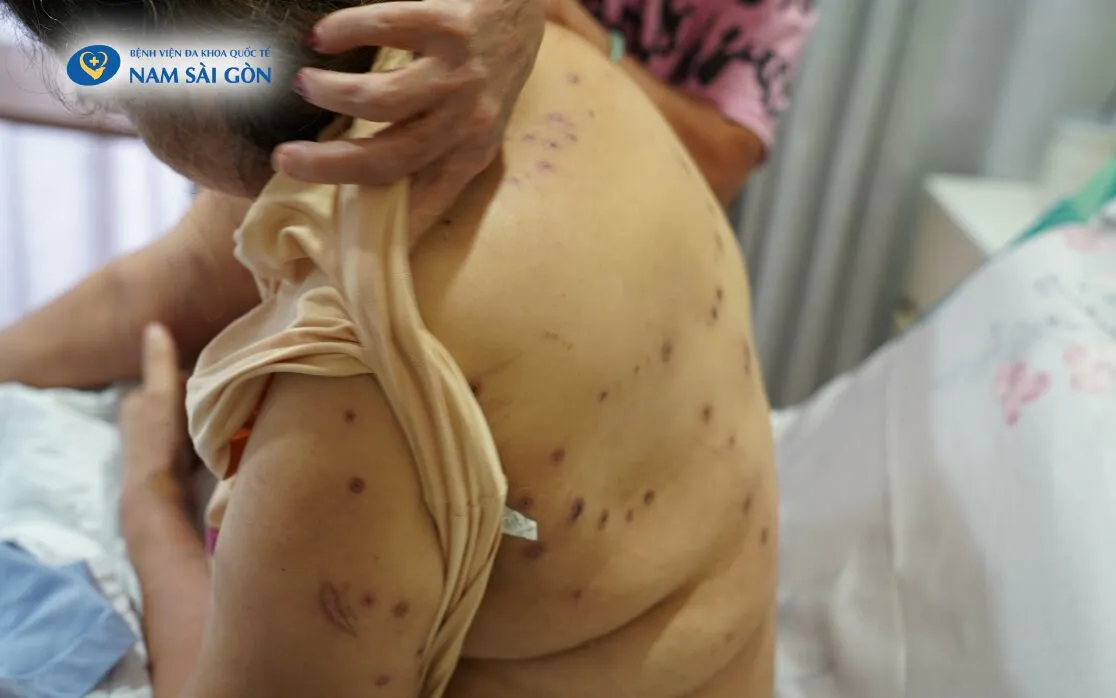 Vết đốt ong vò vẽ ở đầu, mặt, lưng, tay chân minh họa nguy cơ khi đến gần tổ